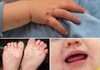 Số ca mắc tay chân miệng ở trẻ tại Quảng Ninh tăng đột biến