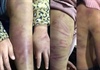 Hà Nội: Khẩn trương làm rõ bé gái 12 tuổi bị mẹ bạo hành